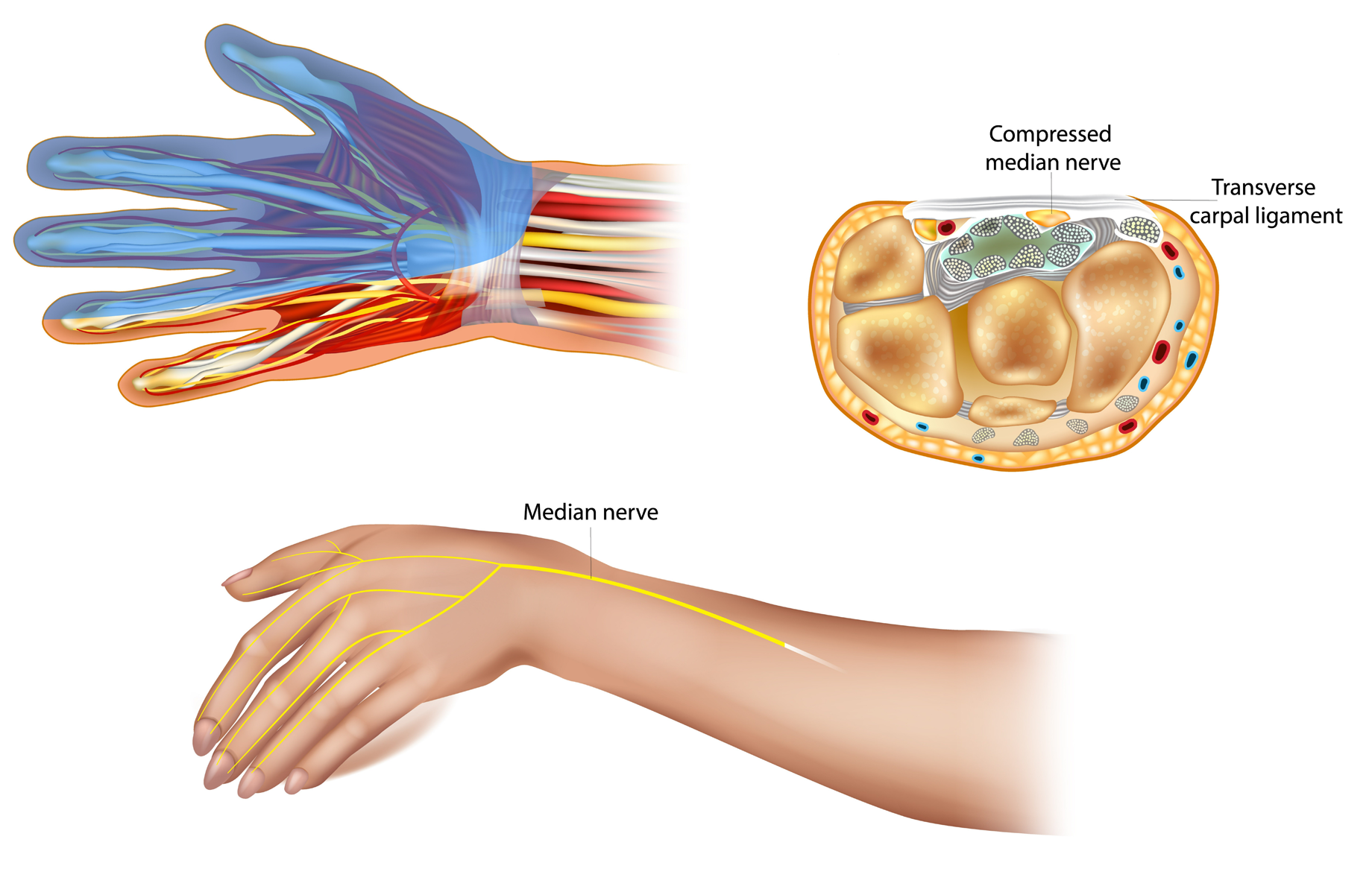 A close-up of carpal tunnel syndrome, showing a compressed median nerve. Also, showing the location of the median nerve. Source: Veterans Affairs Canada (2024).