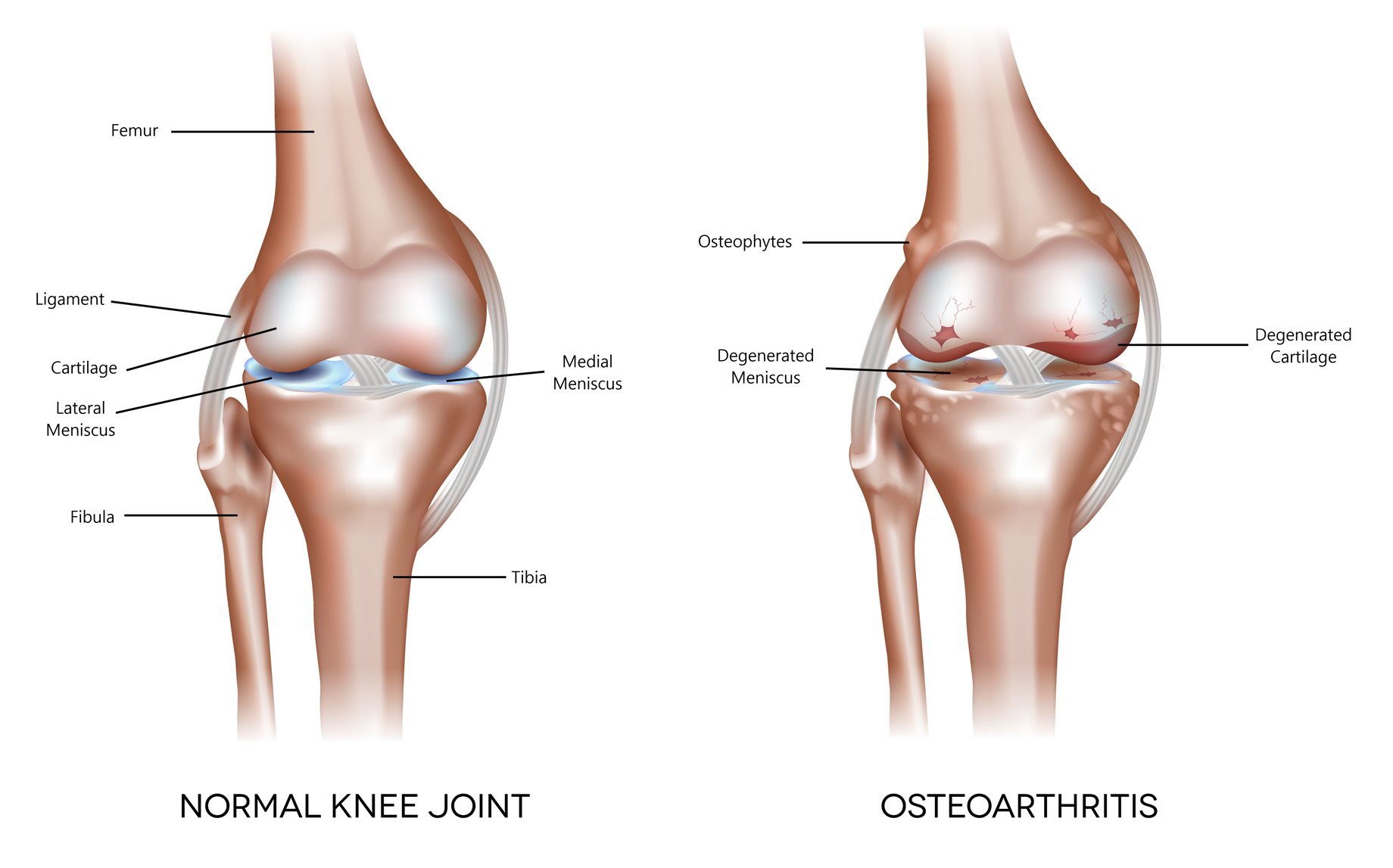 A diagram of a normal knee joint, and a joint with osteoarthritis.